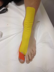 K-Taping